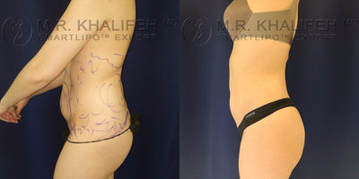 25-34 year old woman treated with Laser Liposuction - This patient underwent a smart lipo of the abdomen and lower back flanks. Her skin tone was excellent, despite having had one child prior to surgery. A pleasing change in contour is achievable without noticeable scarring.