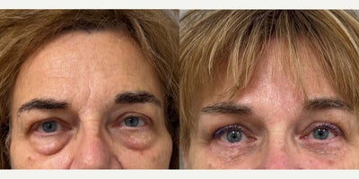 65 yo s/p pretrichial brow lift and lower blepharoplasty with skin pinch and canthopexy performed under twilight sedation in our - 65 yo s/p pretrichial brow lift and lower blepharoplasty with skin pinch and canthopexy performed under twilight sedation in our on site AAAA certified operating suite.
