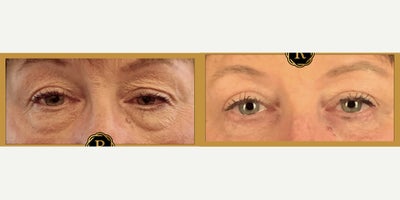 55-64 year old woman treated with Eyelid Surgery - 55-64 year old woman treated with Eyelid Surgery