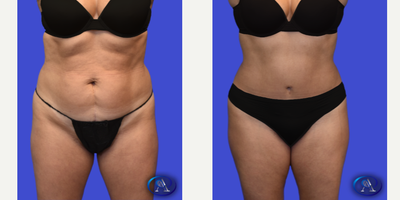 45-54 year old woman treated with Tummy Tuck, Liposuction, Umbilical Hernia Repair - 46-year-old patient 6 months post abdominoplasty + hernia repair with liposuction to flanks