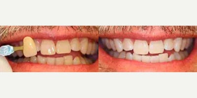 Woman treated with Teeth Whitening - Woman treated with Teeth Whitening