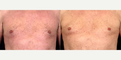 70 year old man treated with Nipple reduction - 70 year old man treated with Nipple reduction Photos depict before and 6 months after surgery