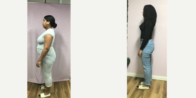 25-34 year old woman treated with Endoscopic Sleeve Gastroplasty - Our patient lost 61 Lbs in 5 months after the Endoscopic Sleeve Gastroplasty procedure.