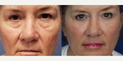 Woman treated with Eyelid Surgery - Woman treated with Eyelid Surgery