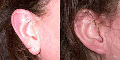 Woman treated with Ear Surgery by Toronto Plastic Surgeon Dr. Leila Kasrai - Earlobe reshaping and hole correction.