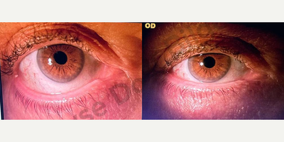 Woman treated with Eyelid Retraction Repair - Lower eyelid retraction repairs post-op 1-month result.