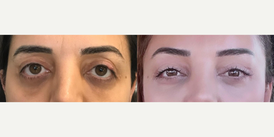 Woman treated with Eyelid Retraction Repair - Following an aesthetic eyelid surgery performed elsewhere, the patient was both aesthetically and functionally dissatisfied, experiencing impaired eyelid closure function. I was pleased to see the happiness captured in the photograph taken after the revision surgery we performed.