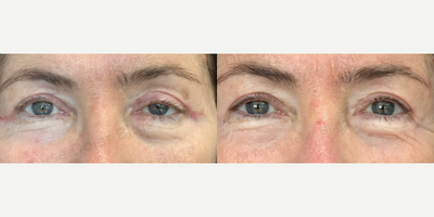 Woman treated with Ptosis Surgery - Woman treated with Ptosis Surgery