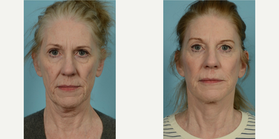 Woman treated with Lower Facelift - Woman treated with Lower Facelift
