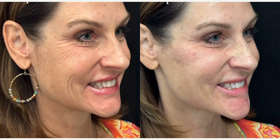 Woman treated with Juvederm, Dermal Fillers - Woman treated with Juvederm, Dermal Fillers