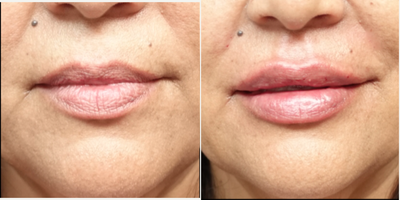 45-54 year old woman treated with Restylane Silk - The patient underwent lip augmentation with Restylane. The filler adds a natural but sexy appearance to her lips. The pictures show her transformation in this twenty minute procedure. Lip enhancement and replenish the volume patients have lost in their lips as we age, or create the lips they have always desired.
