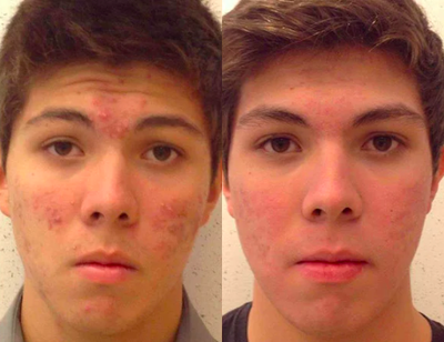 Accutane - Acne treatment