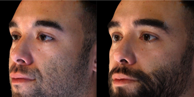 25-34 year old man treated with Contour Thread Lift - Thread Lift through Temples plus Volume with Sculptra