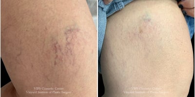 35-44 year old woman treated with Skin Rejuvenation - This patient underwent a single session of Laser Vein Removal to target visible spider veins on the outer thigh.Her results show a noticeable reduction in red and purple broken blood vessels, along with a softer, more even skin tone where clusters of surface veins were previously prominent. Laser vein therapy works by delivering targeted energy to the affected vessels, causing them to collapse and fade over time without damaging the surrounding skin.This one-treatment improvement highlights how effective laser vein removal can be for minimizing spider veins, enhancing skin clarity, and restoring confidenceespecially for patients looking for a quick, nonsurgical solution with minimal downtime.