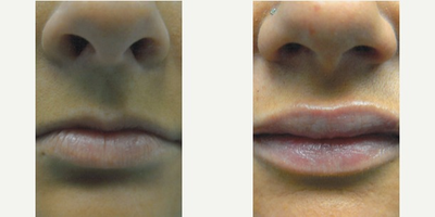 25-34 year old woman treated with Lip Implants - 25 year old 6 months after lip implant