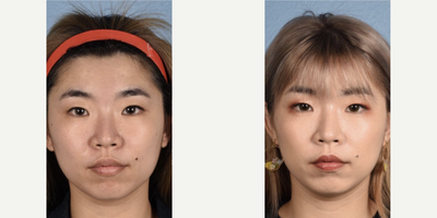 25-34 year old woman treated with Thermage - Our patient is only 2 months post thermage to her full face. Thermage is a non-invasive treatment that helps to lift and tighten the skin.
