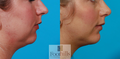 Woman treated with Chin Implant - Woman treated with Chin Implant