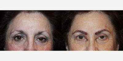Woman treated with Eyebrow Transplant - Woman treated with Eyebrow Transplant