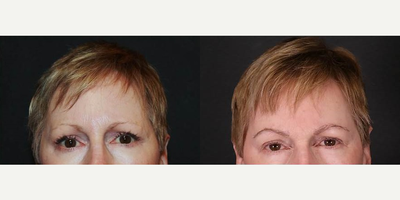 Woman treated with Eyebrow Transplant - Woman treated with Eyebrow Transplant