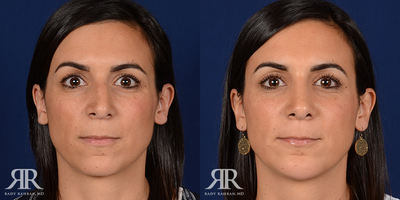Chin Surgery - Chin Augmentation