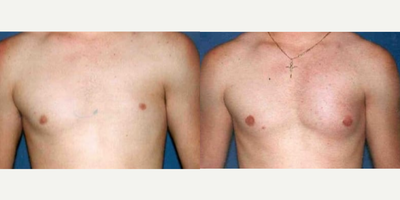 Man treated with Pec Implants - Man treated with Pec Implants