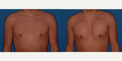 Man treated with Pec Implants - Man treated with Pec Implants