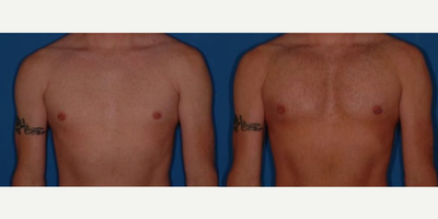 Man treated with Pec Implants - Man treated with Pec Implants