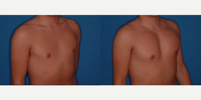 Man treated with Pec Implants - Man treated with Pec Implants