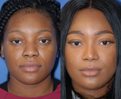 22 year old woman treated with African American Rhinoplasty - 22 year old woman treated with African American Rhinoplasty