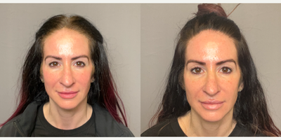 35-44 year old woman treated with Lip Fillers, Restylane - lip filler