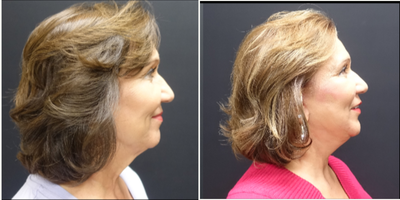 65-74 year old woman treated with Facelift - The patient underwent a high lateral SMAS face and necklift. The SMAS elevation supports the facelift so that their is minimal tension on the skin and enhance the possible longevity of the face and necklift. Along with the face and necklift she also had fat transfer to the face. Fat was transferred tough out the face and temples to restore the volume she has lost over time as we age. The combination of tightening and filling of the face gives her a much more youthful but natural appearance. This pictures show her two month result.