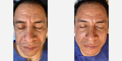 Man treated with HydraFacial - Man treated with HydraFacial