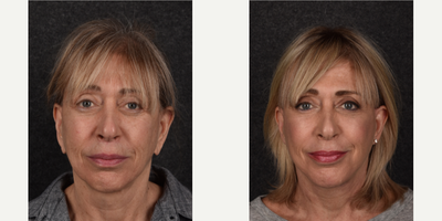 65-74 year old woman treated with Facelift Revision - This patient underwent a SMAS facelift several years ago and returned for a revision. She underwent a deep plane facelift with earlobe reduction and full face fractional CO2 laser treatment