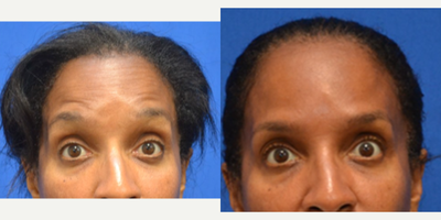 55-64 year old woman treated with Daxxify - Improved foreheadInjected by Scarlet PA-C