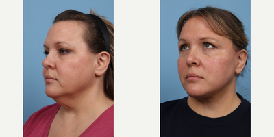 45-54 year old woman treated with Facelift - 6 weeks post deep plane facelift