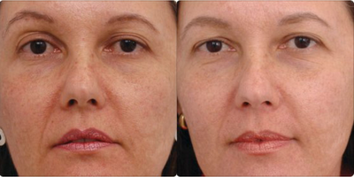 Pixel Laser - Woman treated with Pixel Laser