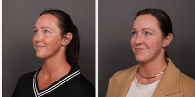 35-44 year old female treated with BroadBand Light (BBL), Moxi, Lip Fillers - 2 BBL and Moxi treatments by Katherine Small, and a half syringe of lip filler by Moriah Carr. Age 38. 1 month post-treatment.