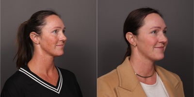 35-44 year old female treated with BroadBand Light (BBL), Moxi, Lip Fillers - 2 BBL and Moxi treatments by Katherine Small, and a half syringe of lip filler by Moriah Carr. Age 38. 1 month post-treatment.