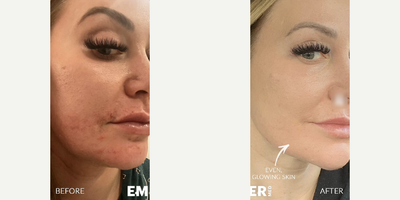 Woman treated with Moxi - Woman treated with Moxi