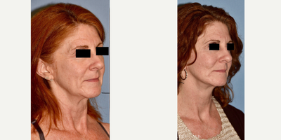 55-64 year old woman treated with Facelift - Facelift, neck lift, and facial fat transfer.