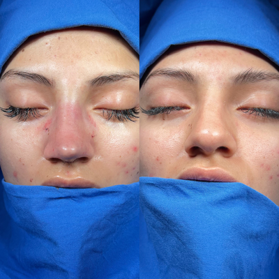 Rhinoplasty - STRUCTURAL RHINOPLASTY