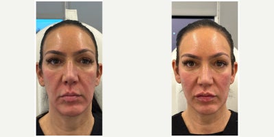 45-54 year old woman treated with Dermal Fillers, Lip Fillers - Patient in her late 40's wanted to restore volume loss that she's noticed through the aging process. The goal was not to make her look different, but to remind the clock so that she still looks like herself. Nurse Cindy focused on restoring lip volume in addition to a more youthful curved and volumized cheek and jawline structure.