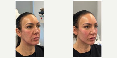 45-54 year old woman treated with Dermal Fillers, Lip Fillers - Patient in her late 40's wanted to restore volume loss that she's noticed through the aging process. The goal was not to make her look different, but to remind the clock so that she still looks like herself. Nurse Cindy focused on restoring lip volume in addition to a more youthful curved and volumized cheek and jawline structure.