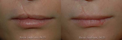 Laser Genesis - Seeking to improve his image, this patient underwent Laser Genesis with our Certified Laser Nurse Specialist.
The Laser Genesis procedure utilizes non-invasive laser technology to safely, naturally and effectively treat fine line wrinkles, diffuse redness and scars.