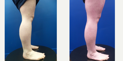 18-24 year old woman treated with Calf Reduction - 24-year-old lady underwent Power & Laser-assisted Liposuction of the Calves, Ankles & Lateral Feet.