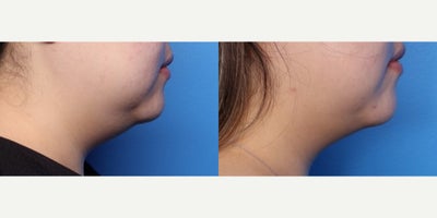 25-34 year old woman treated with FaceTite - 30 year old female shown 6 months after FaceTite liposuction to her neck/lower face. She had a nice reduction in her neck profile and to her jowls.