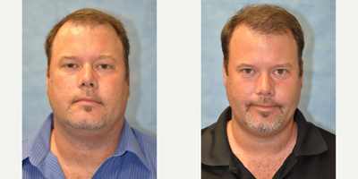 45-54 year old man treated with Hair Transplant - NeoGraft Procedure - 2000 grafts
