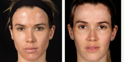 Woman treated with TCA Peel - Our patient used to be plagued by horrible acne that covered her face. After putting her on Accutane to clear most of that acne up, we treated her with a chemical peel called Revepeel, which targets acne, hyperpigmentation, and wrinkles to rejuvenate her face beautifully. She was absolutely thrilled with her results and considers us her go-to for all facial treatments.What is Accutane?Accutane is a retinoid medication that is geared toward clearing up clogged pores by increasing skin cell turnover. This effectively clears acne.