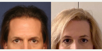 Woman treated with Forehead Reduction - Woman treated with Forehead Reduction