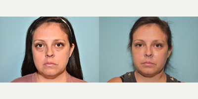25-34 year old woman treated with Injectable Fillers - 33 year old female with lower eyelid hollowing with Restylane filler placed into tear trough to smooth contour.